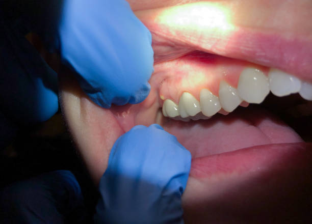 Best Broken Tooth Emergency  in Cabana Colony, FL